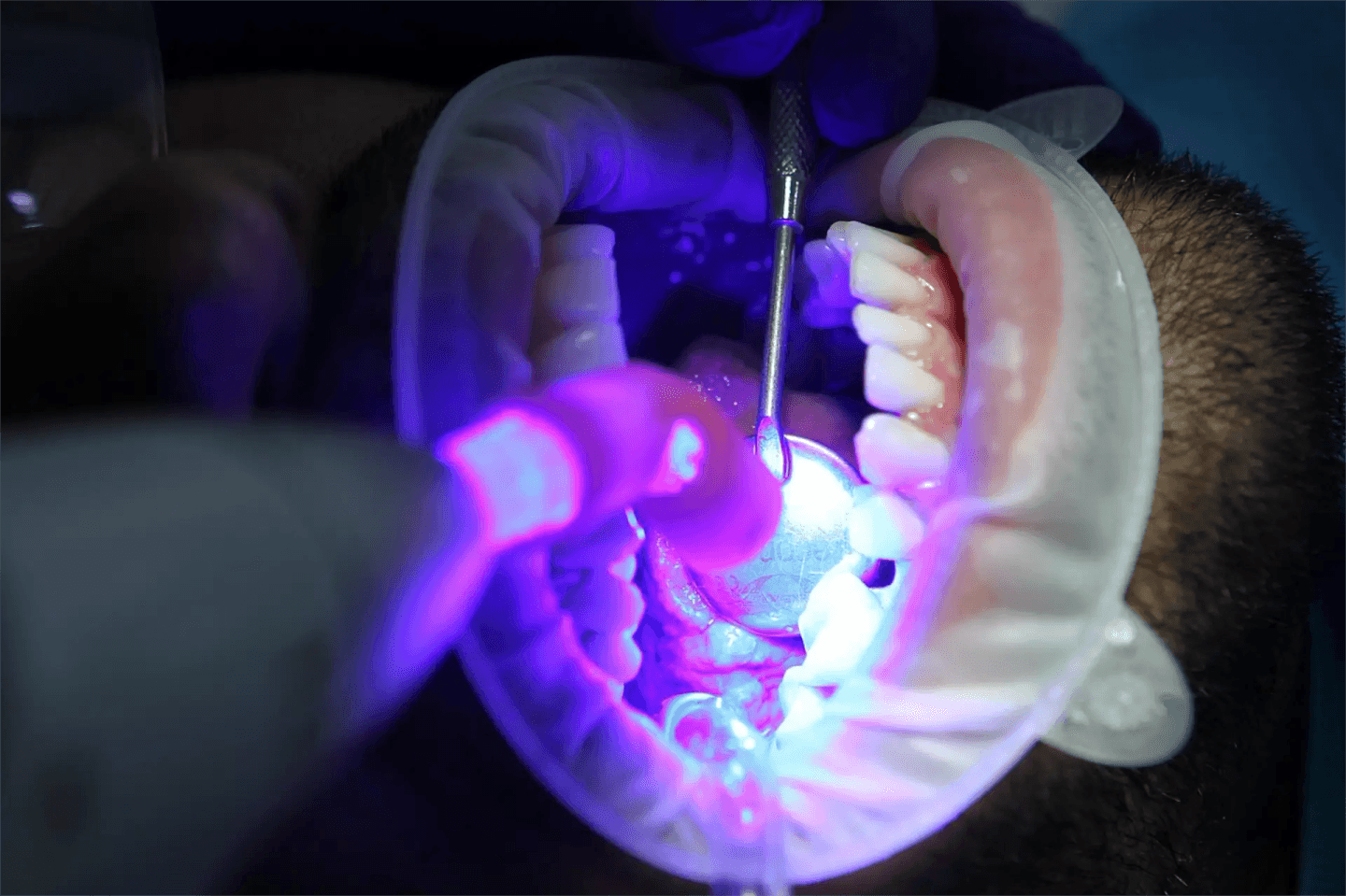 Un primer plano de la boca de un paciente durante un tratamiento dental, resaltando las herramientas dentales y una luz azul utilizada para curar los materiales.