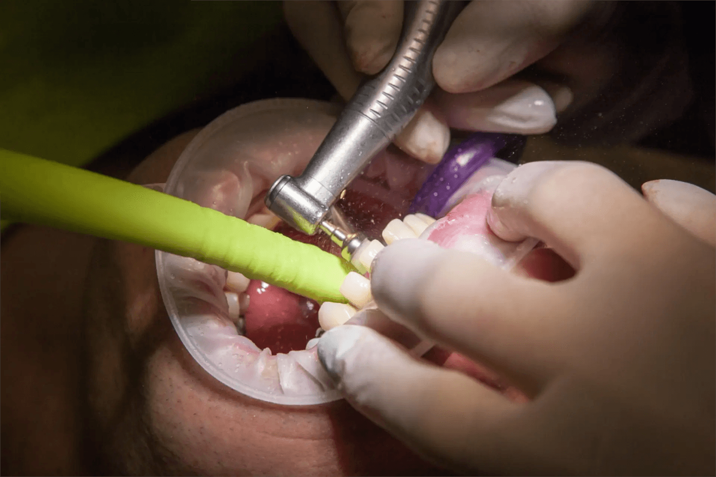 Primer plano de un procedimiento dental, que muestra las manos de un dentista trabajando con herramientas en la boca de un paciente, centrándose en el cuidado de los dientes y las encías.